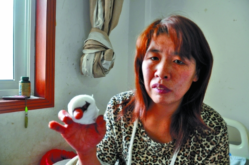 翟女士經(jīng)過首次植皮手術之后的右手