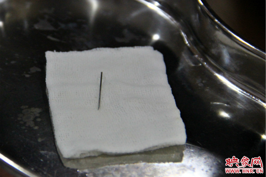 上午11點(diǎn)30分許，小龍腦中鋼針已經(jīng)成功取出。