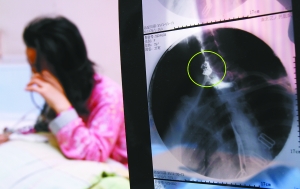 假牙上的鋼絲刺破食管，而薄薄的食道壁緊貼主動脈血管，極易造成血管破裂