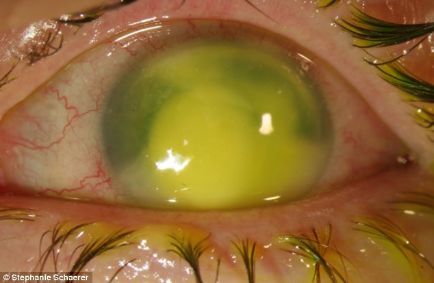 恐怖慎入！隱形眼鏡致英女子摘除眼球