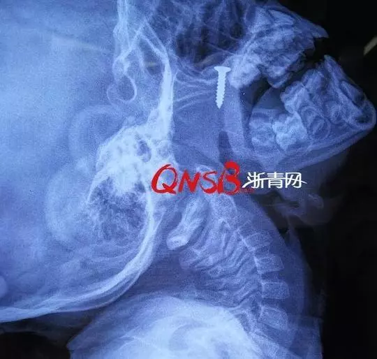 男童睡覺(jué)打鼾突然沒(méi)了呼吸 醫(yī)生從身上取出這東西