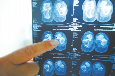 X光片顯示,確實有一根殘留的螺絲釘。