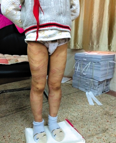 4月3日晚，微博網(wǎng)友“@朝廷半日閑”發(fā)圖文微博展示男童被虐待的慘狀。 微博截圖