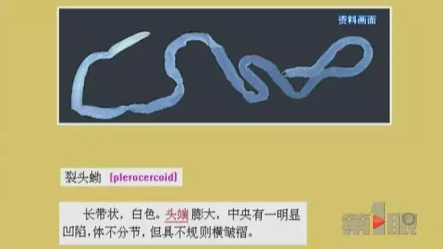 少女大腦皮層萎縮 醫(yī)生從她腦子里捉出5厘米蟲(chóng)子