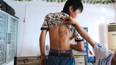 　昨日，奶西村，被打的小剛后背上條條瘀痕依然明顯。