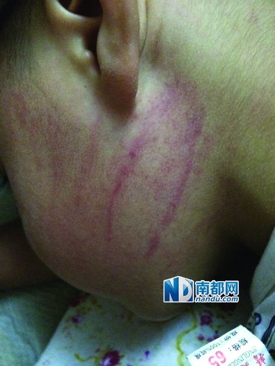 小逸臉上淤痕清晰可見。