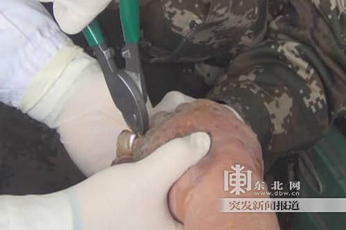 正在拆除戒指。