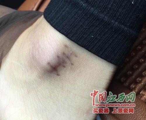 南昌一酒店玻璃門(mén)爆裂顧客多處割傷 店方拒賠償