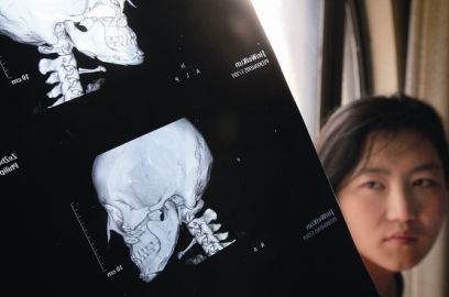 國內(nèi)醫(yī)院CT顯示，如今靳魏坤的鼻子假體是歪的，連下巴也是歪的