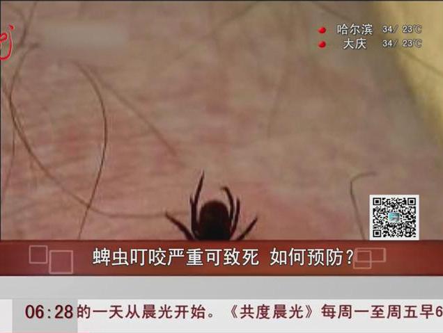 蜱蟲叮咬嚴(yán)重可致死如何預(yù)防？