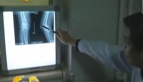 冷空氣來襲 如何預(yù)防老寒腿？